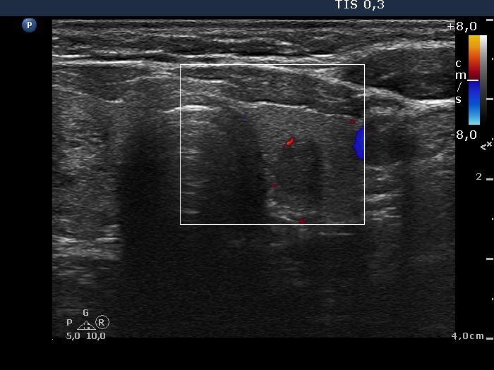 Right lobe, longitudinal scan