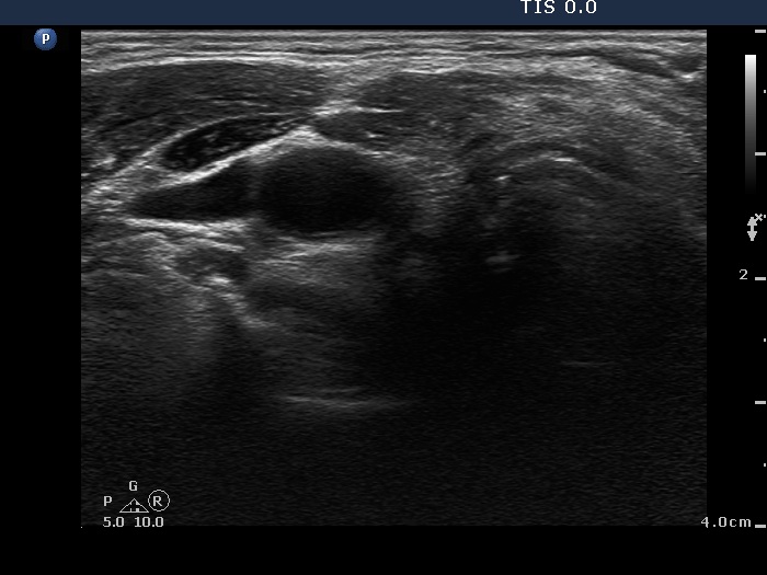 Right lobe, horizontal view