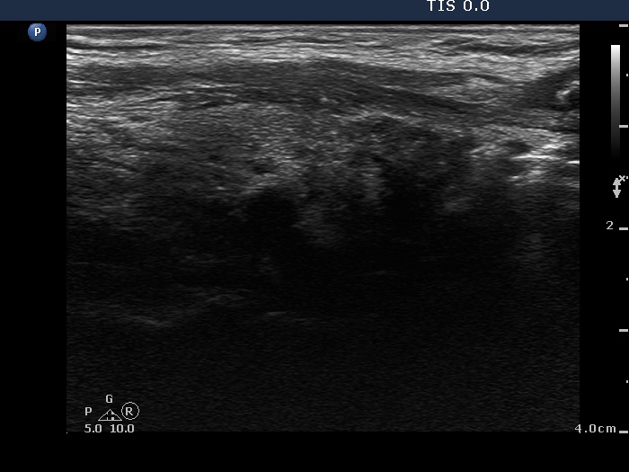 Right lobe, horizontal view