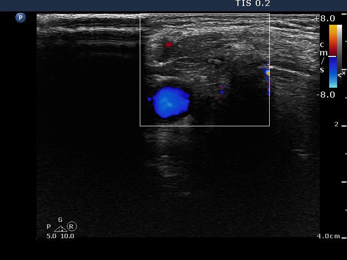 Right lobe, horizontal view