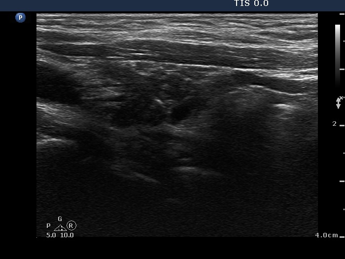 Right lobe, horizontal view