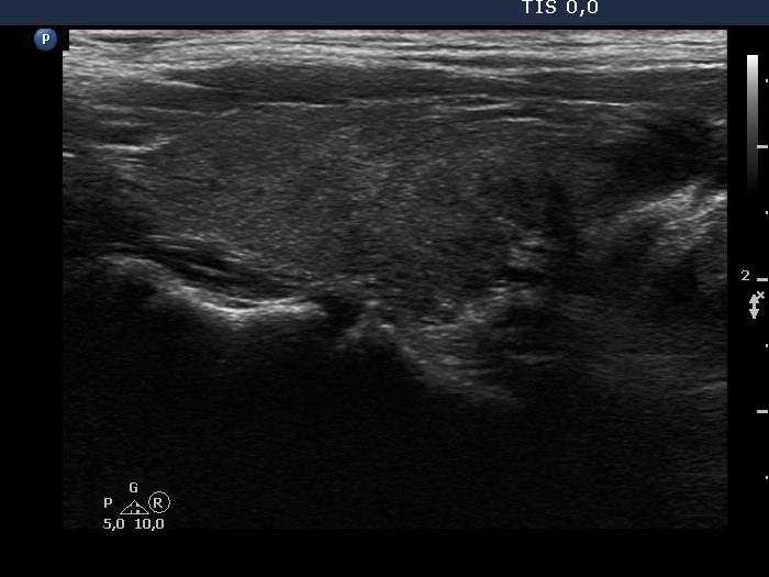 Right lobe, longitudinal scan