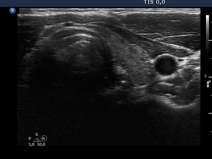 Right lobe, longitudinal scan