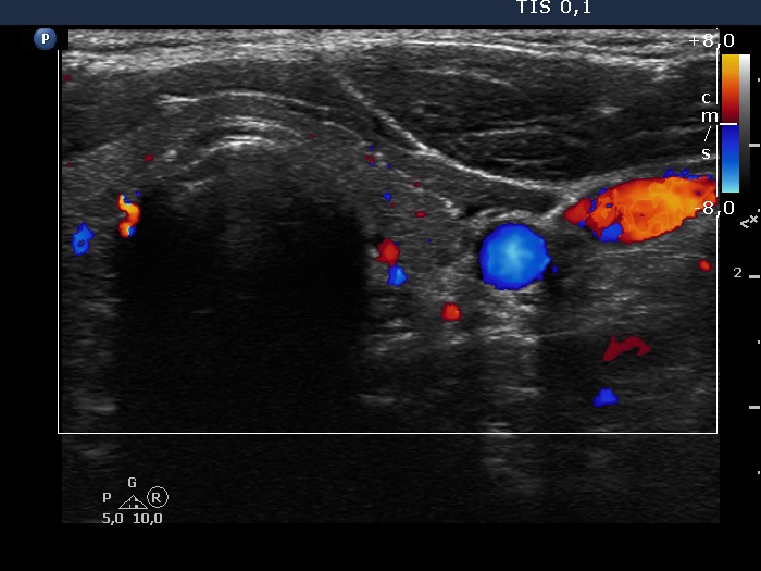 Right lobe, longitudinal scan