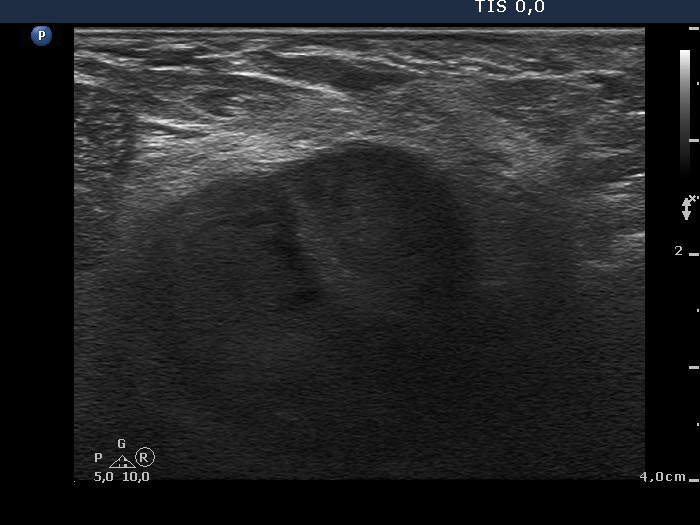 Right lobe, longitudinal scan