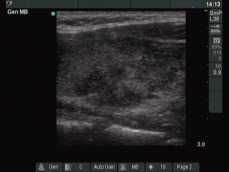 Right lobe, longitudinal scan