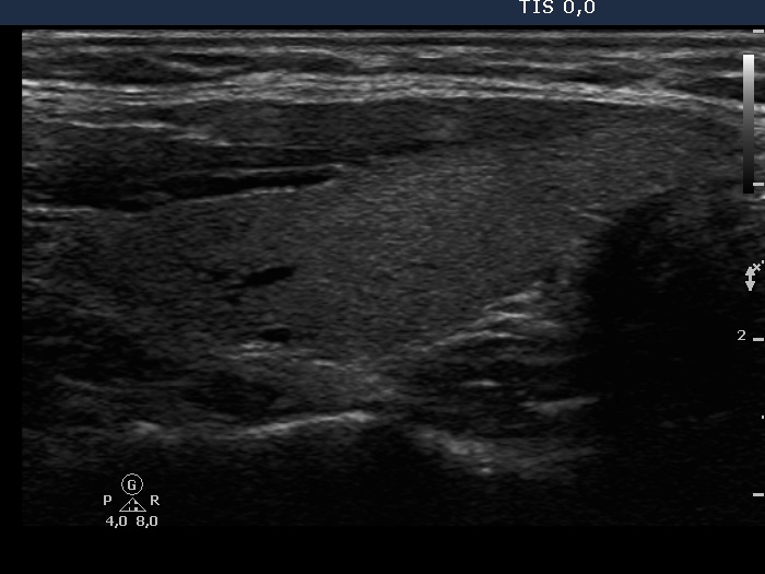 Right lobe, longitudinal scan