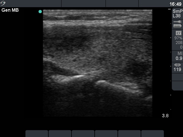 Right lobe, longitudinal scan