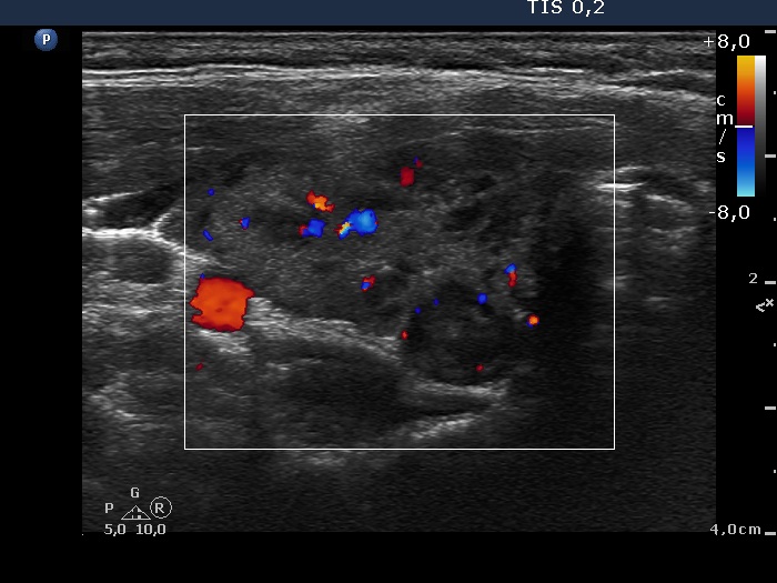 Right lobe, longitudinal scan