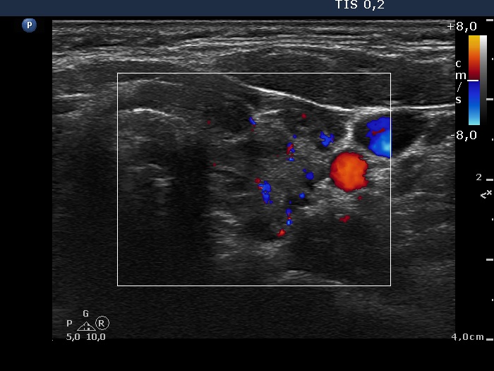 Right lobe, longitudinal scan