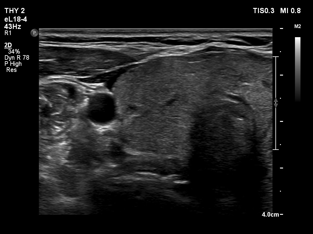 Right lobe, longitudinal scan