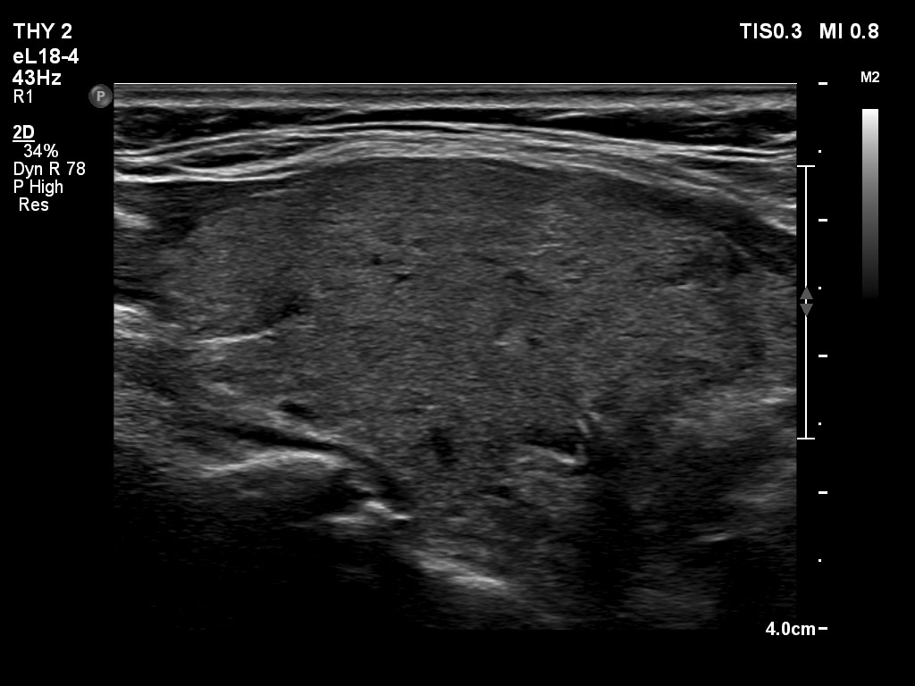 Right lobe, longitudinal scan