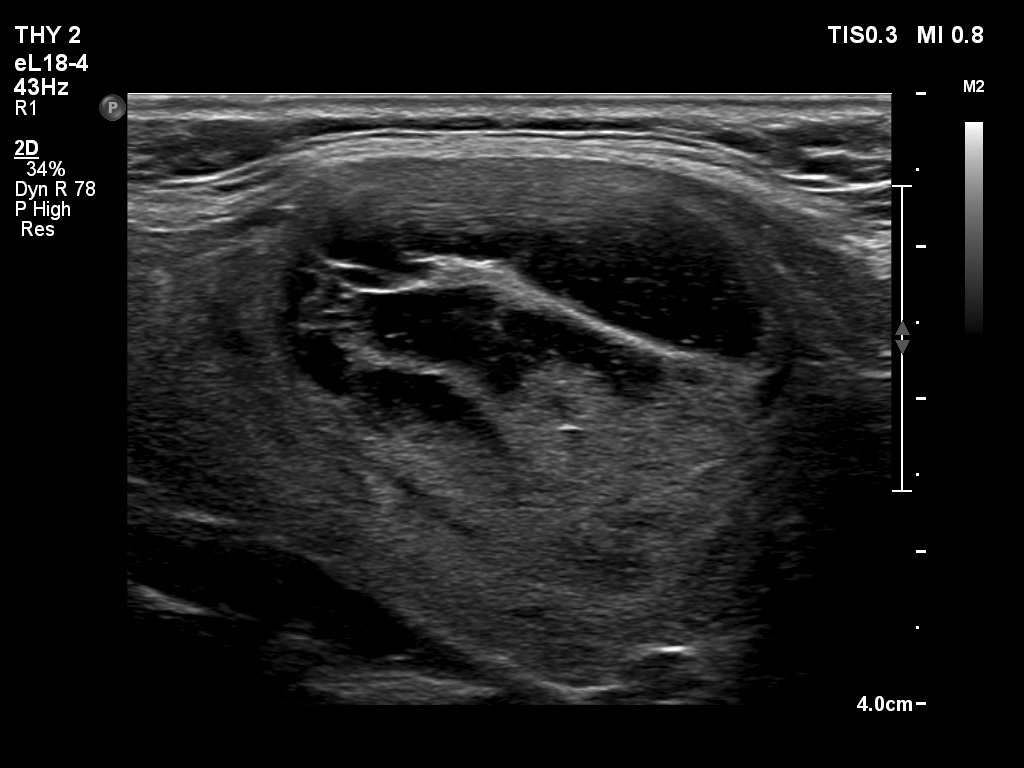 Right lobe, longitudinal scan