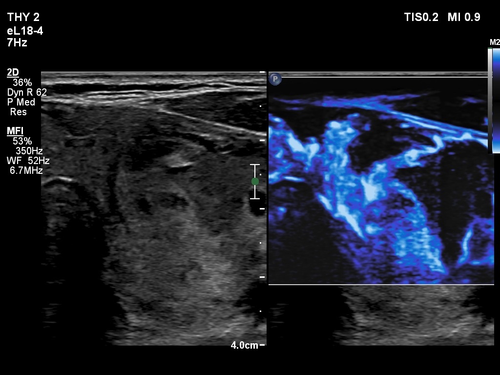 Right lobe, longitudinal scan