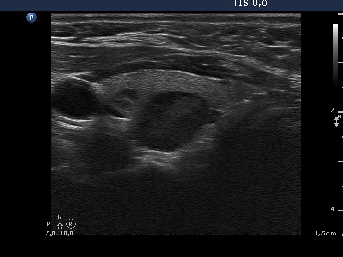 Right lobe, longitudinal scan
