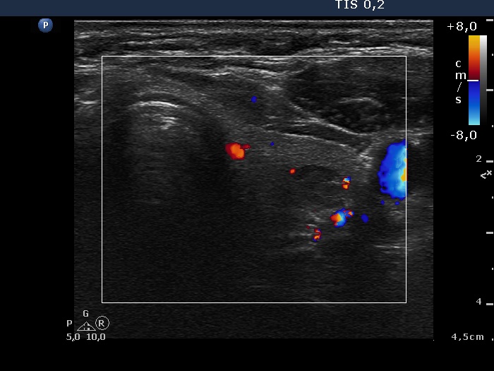 Right lobe, longitudinal scan