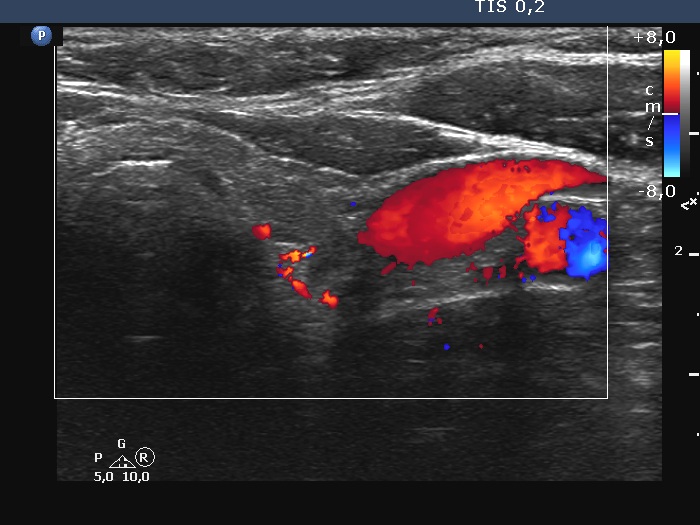 Right lobe, longitudinal scan