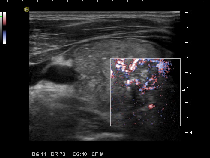 Right lobe, longitudinal scan