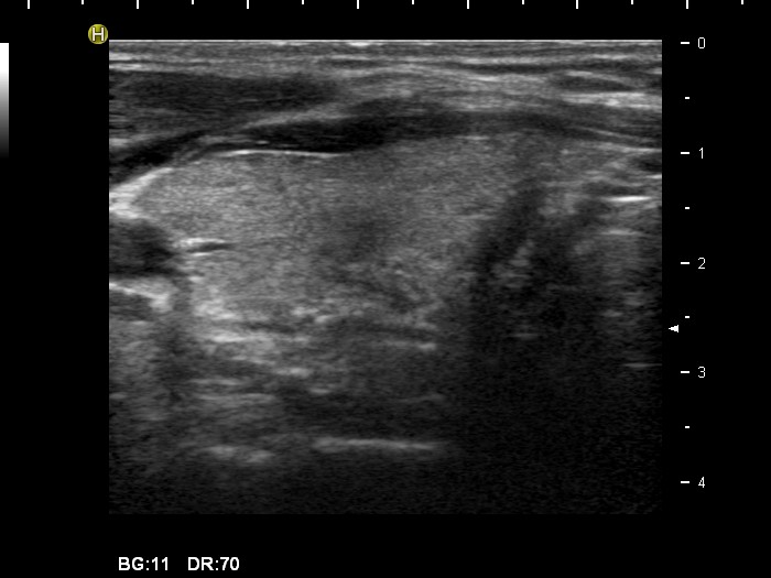 Right lobe, longitudinal scan