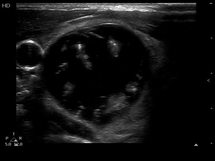 Right lobe, longitudinal scan