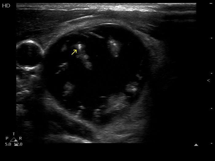 Right lobe, longitudinal scan