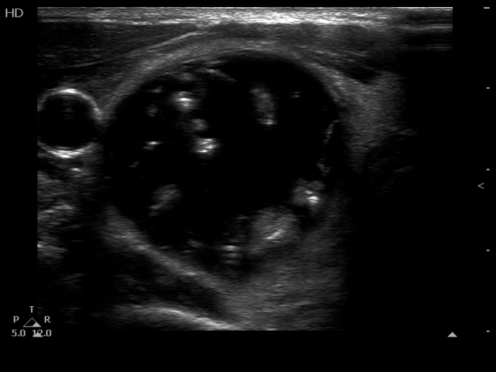 Right lobe, longitudinal scan