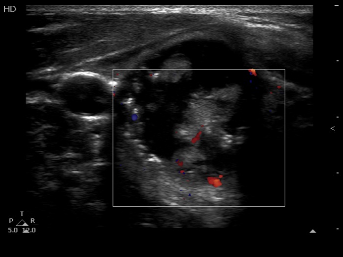 Right lobe, longitudinal scan