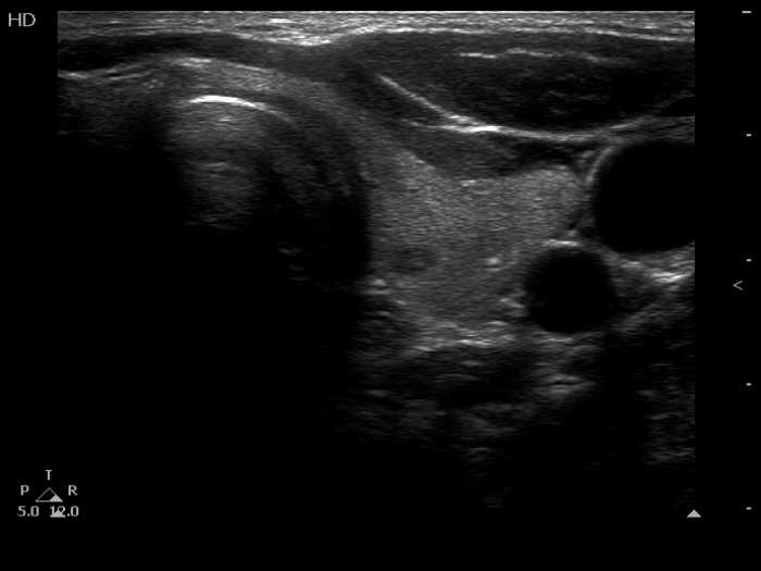 Right lobe, longitudinal scan