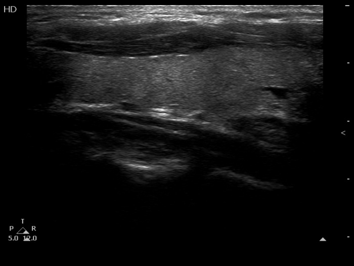 Right lobe, longitudinal scan