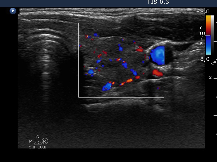 Right lobe, longitudinal scan