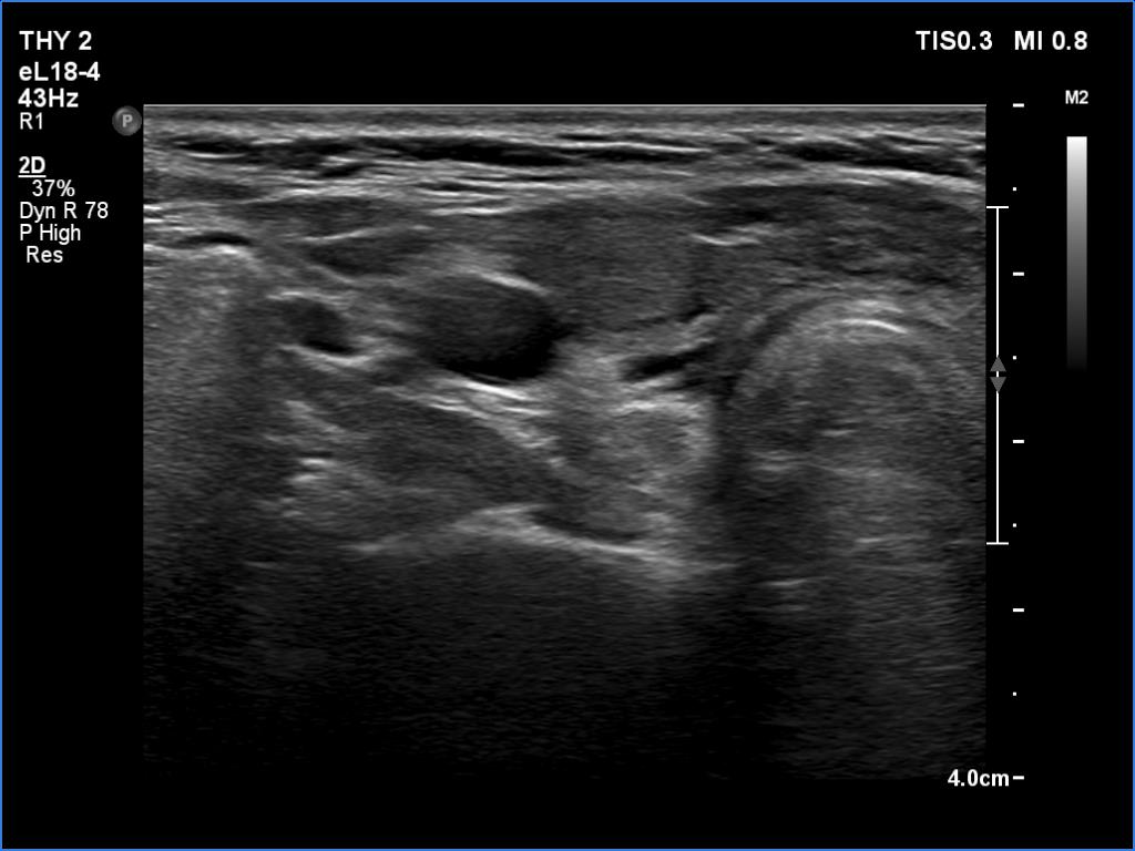 Right lobe, longitudinal scan