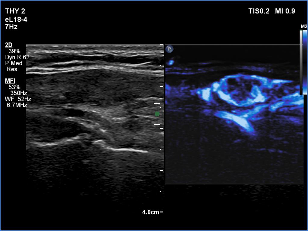 Right lobe, longitudinal scan