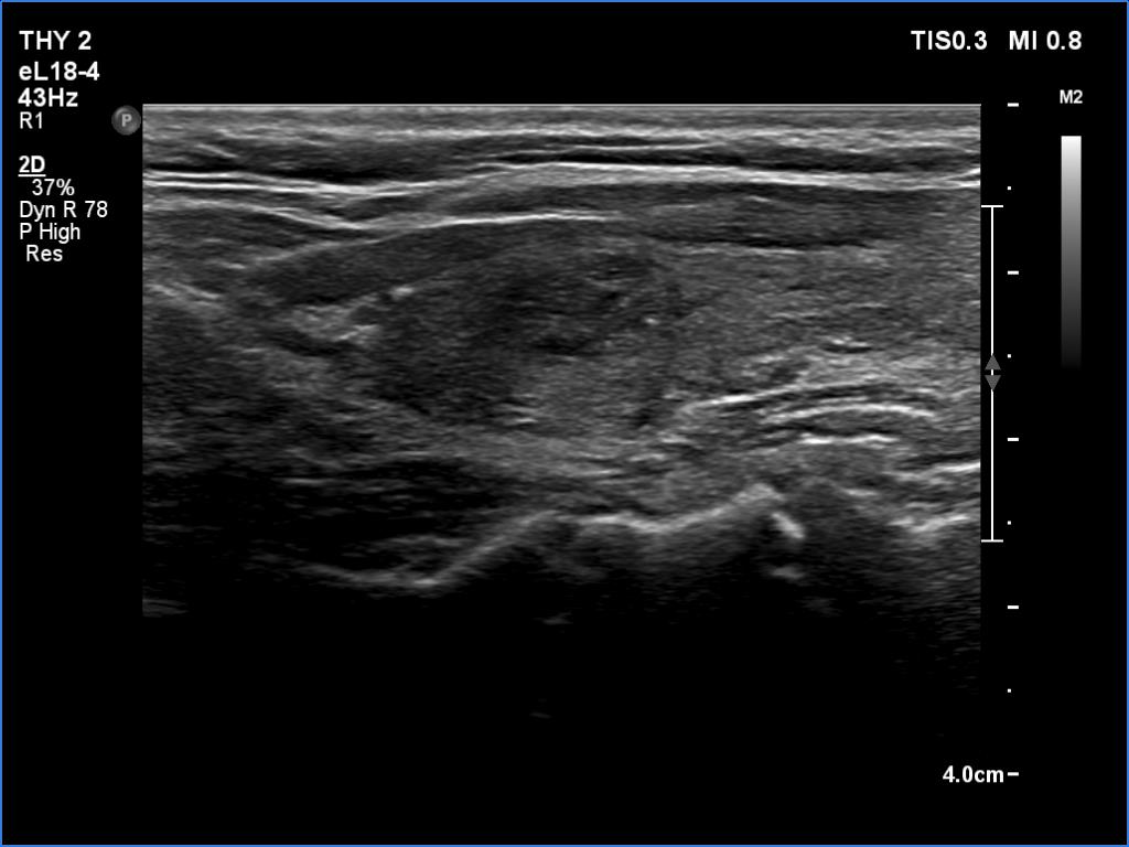 Right lobe, longitudinal scan