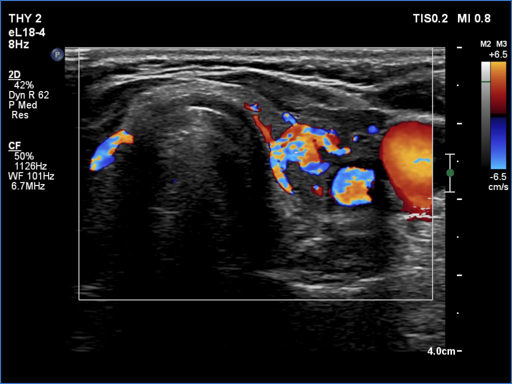 Right lobe, longitudinal scan