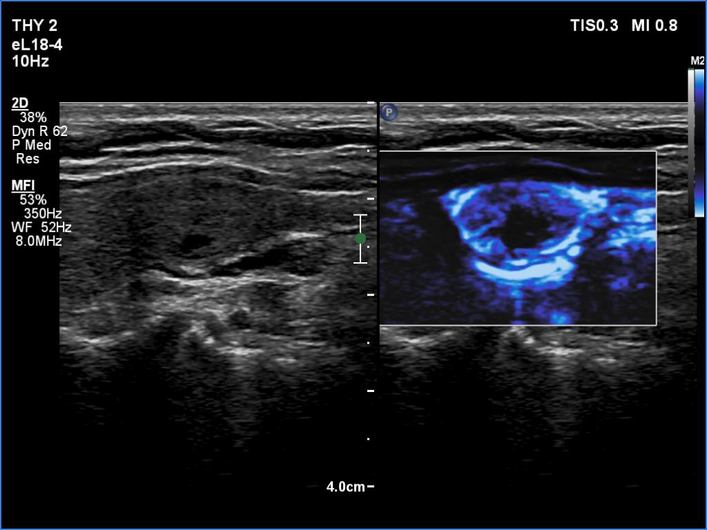 Right lobe, longitudinal scan