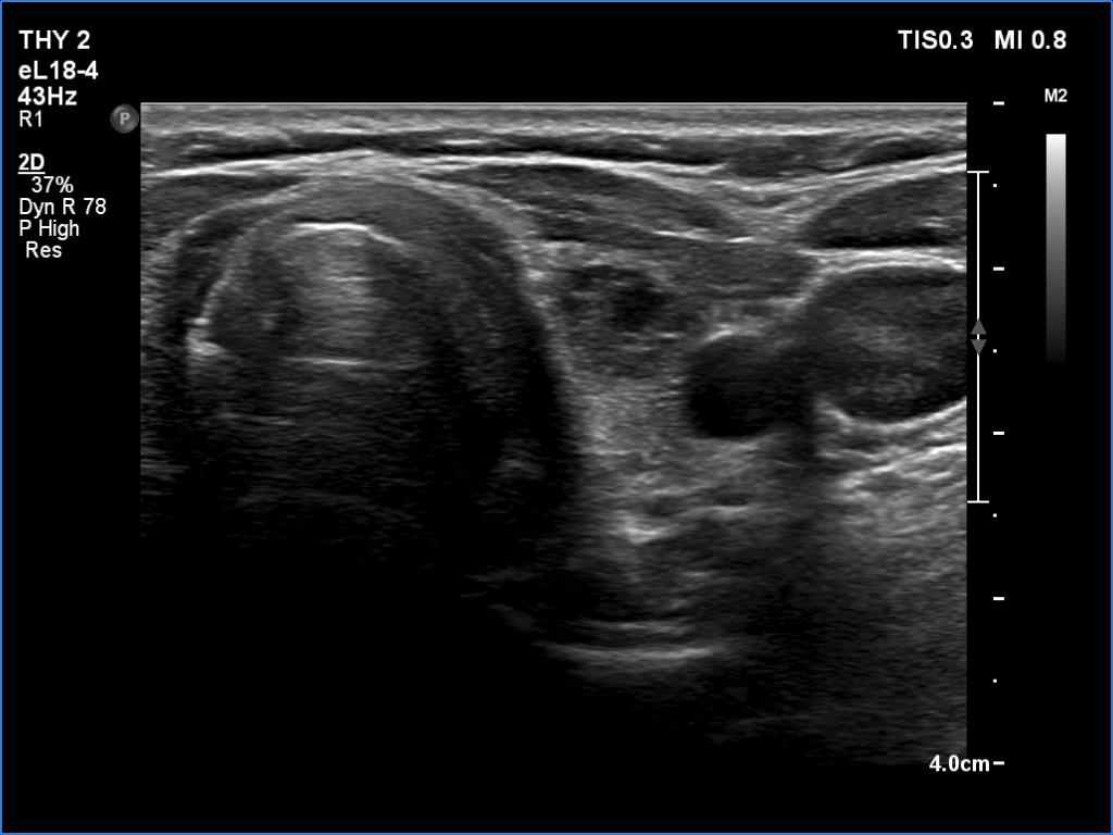 Right lobe, longitudinal scan