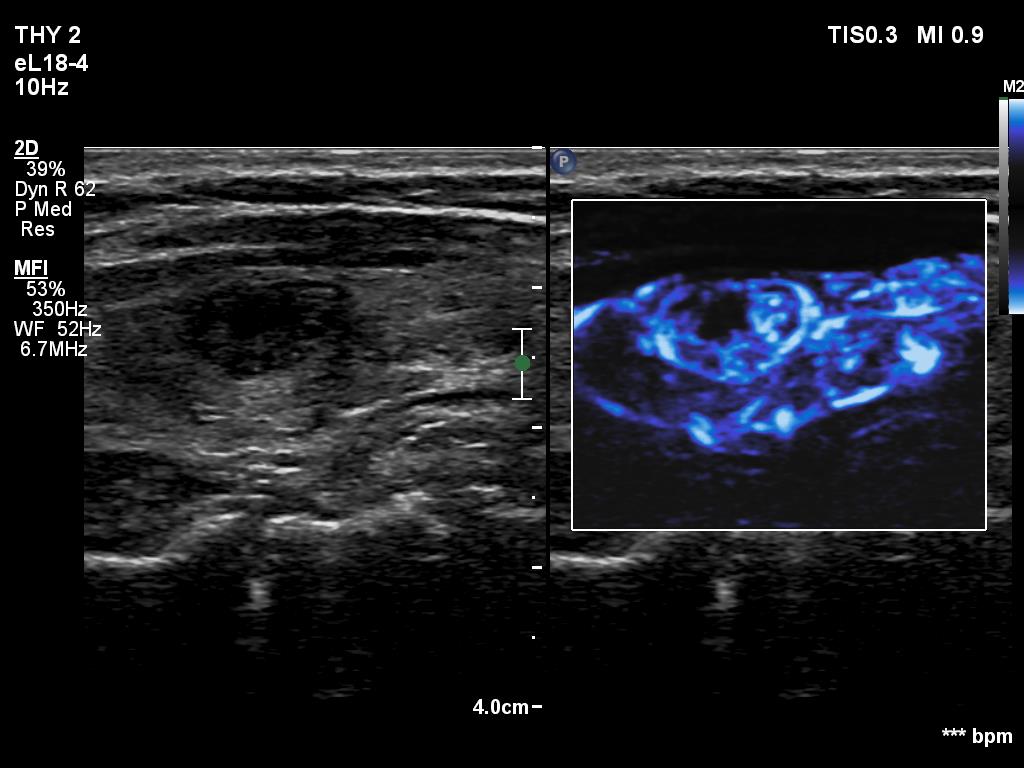 Right lobe, longitudinal scan