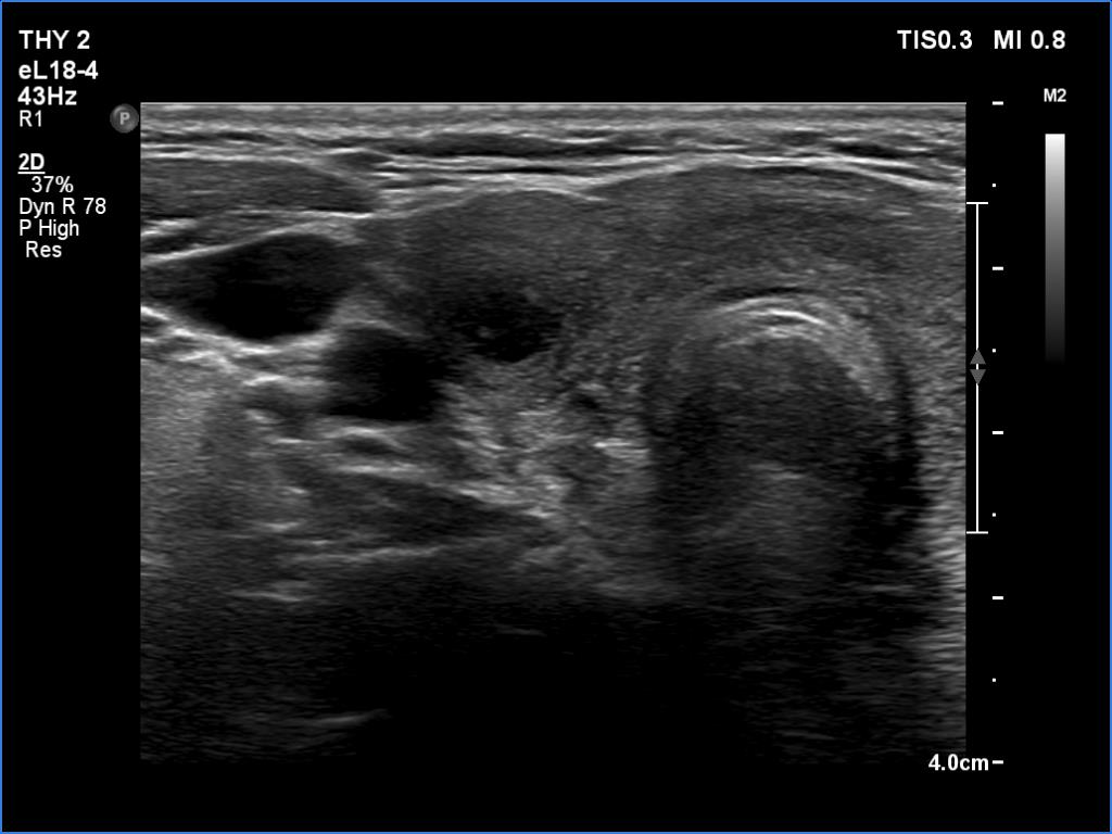 Right lobe, longitudinal scan