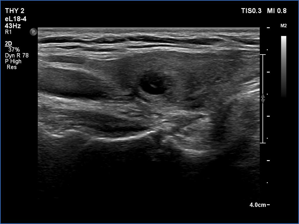 Right lobe, longitudinal scan