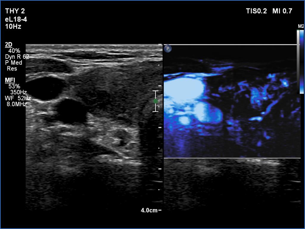 Right lobe, longitudinal scan