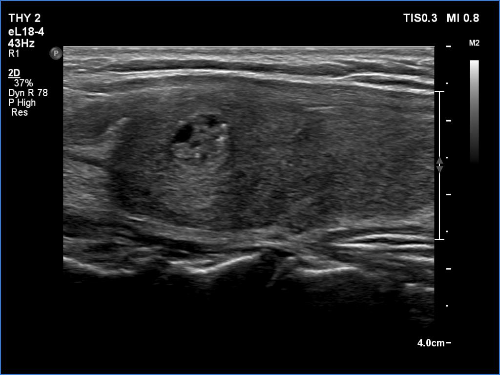 Right lobe, longitudinal scan