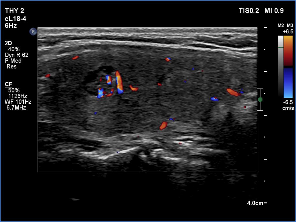 Right lobe, longitudinal scan