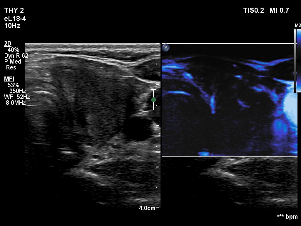 Right lobe, longitudinal scan