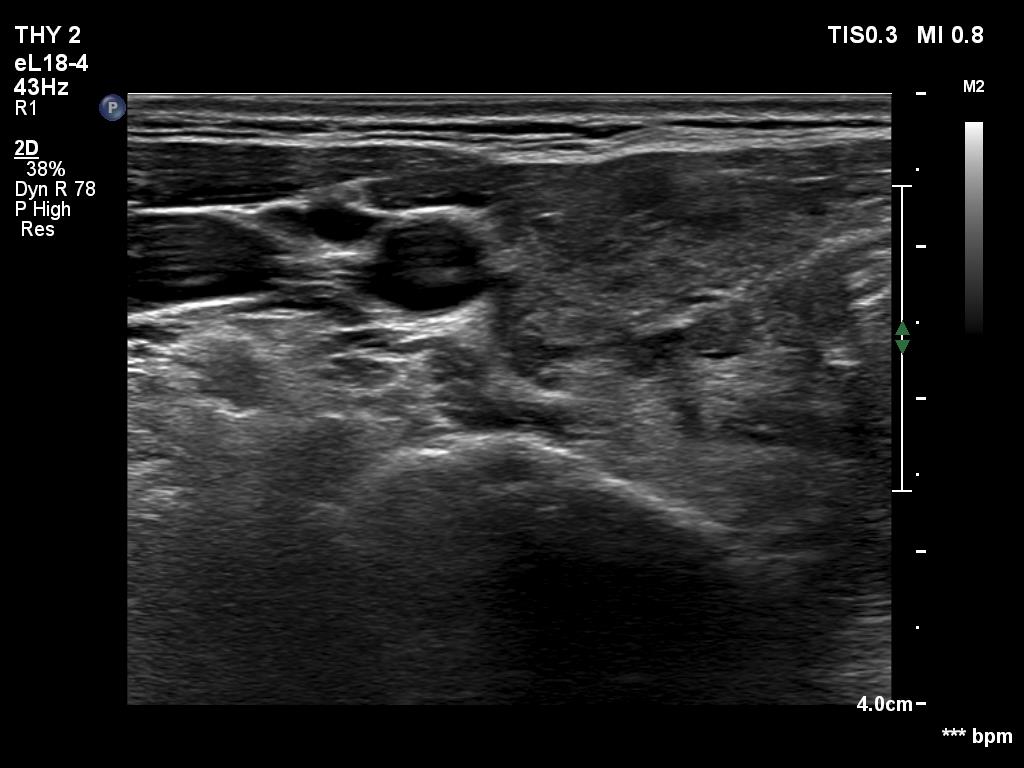 Right lobe, longitudinal scan