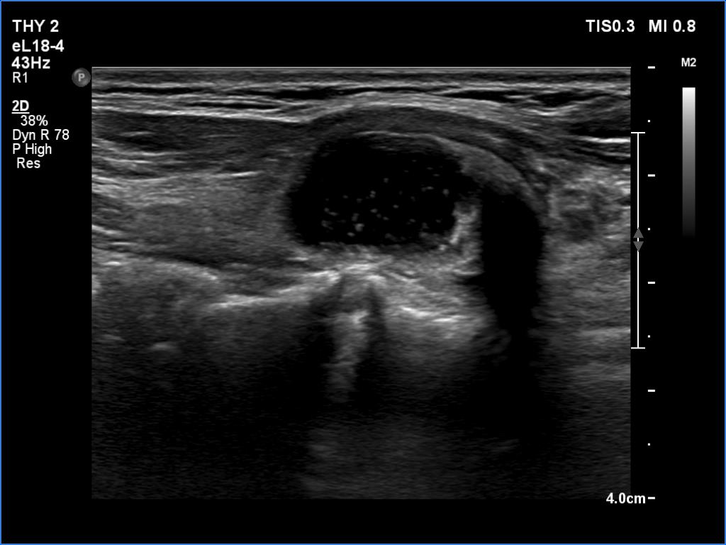 Right lobe, longitudinal scan