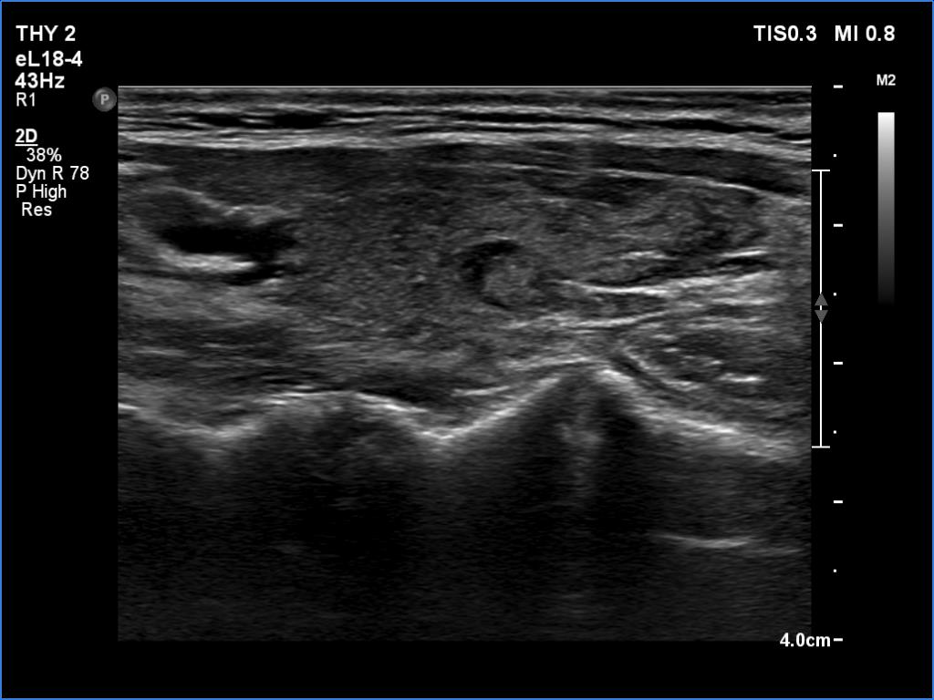 Right lobe, longitudinal scan