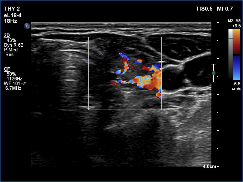 Right lobe, longitudinal scan