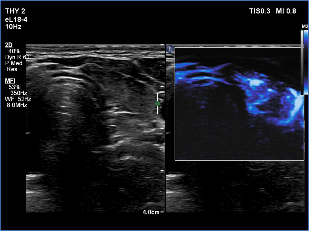 Right lobe, longitudinal scan