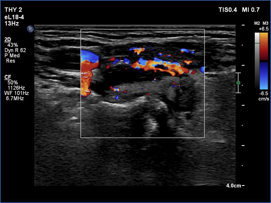 Right lobe, longitudinal scan