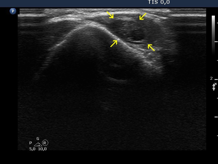 Right lobe, longitudinal scan